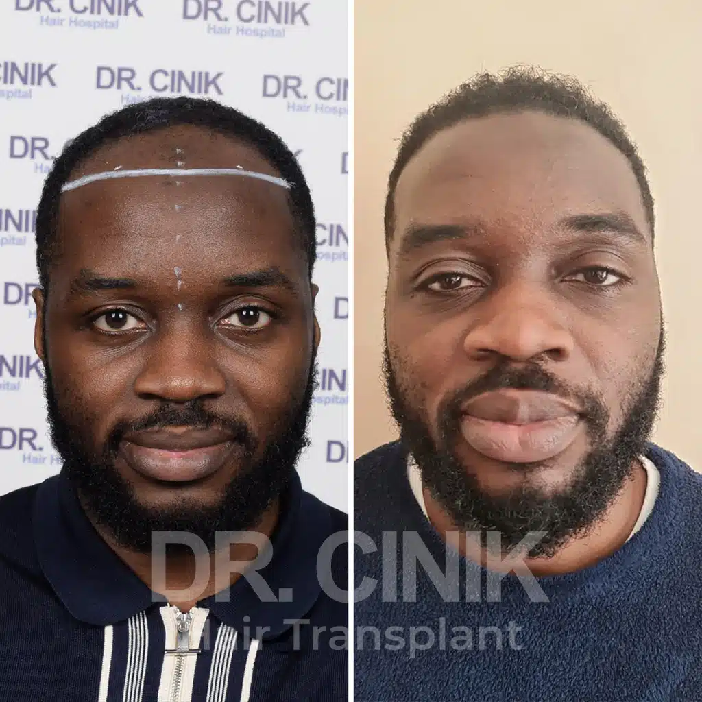 Comparación antes y después de un trasplante capilar afro con 3400 injertos. Patrón inicial Norwood IV mostrando la transformación.