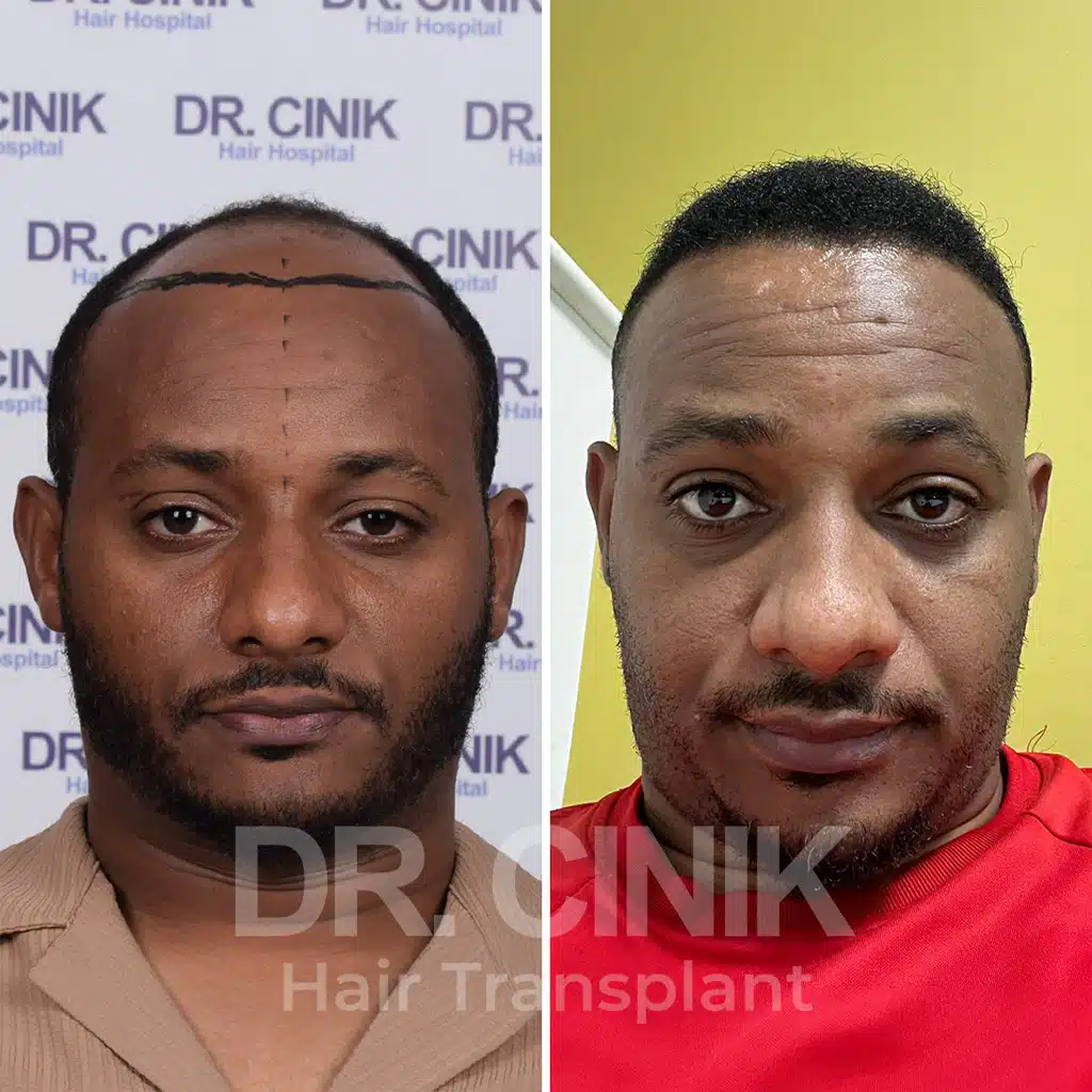 Comparación antes y después de un trasplante capilar afro con 3400 injertos. Patrón inicial Norwood V mostrando la transformación.