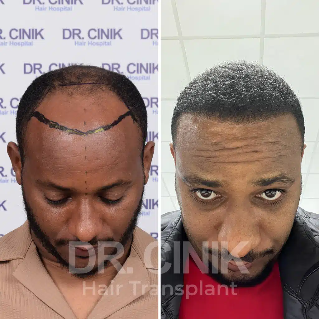 Comparación antes y después de un trasplante capilar afro con 3400 injertos. Patrón inicial Norwood V mostrando la transformación.