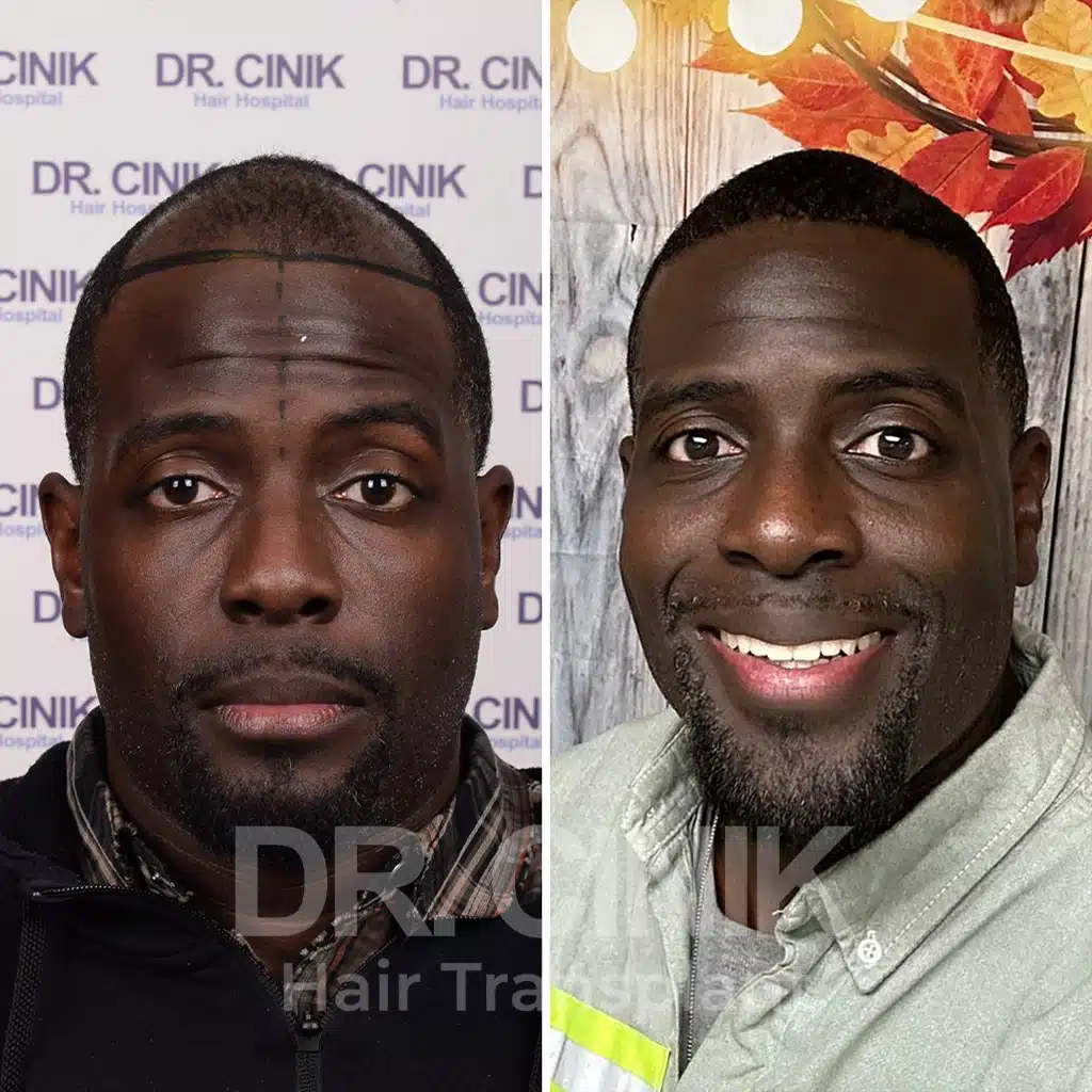 Comparación antes y después de un trasplante capilar afro con 3400 injertos. Patrón inicial Norwood V mostrando la transformación.