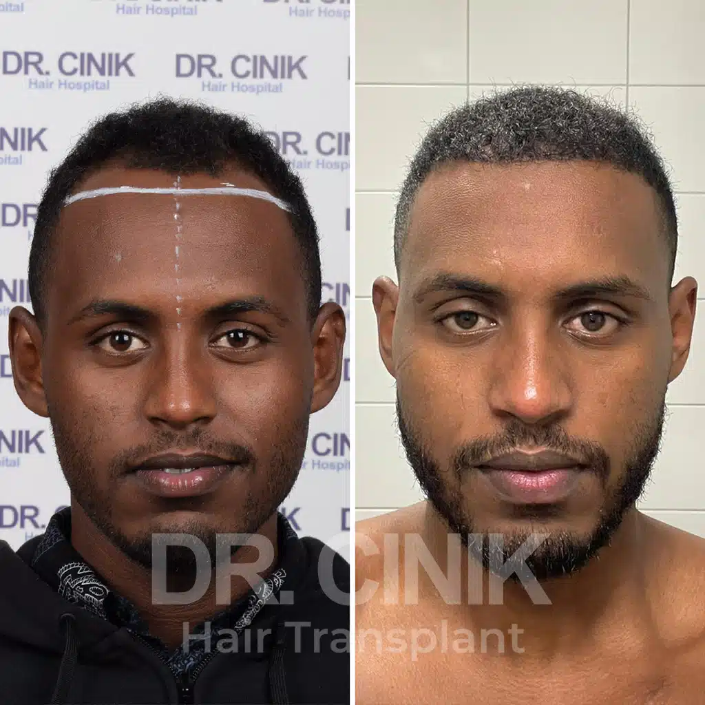 Comparación antes y después de un trasplante capilar afro con 3500 injertos. Patrón inicial Norwood V mostrando la transformación.