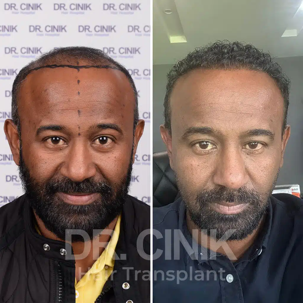 Comparación antes y después de un trasplante capilar afro con 3500 injertos. Patrón inicial Norwood VI mostrando la transformación.
