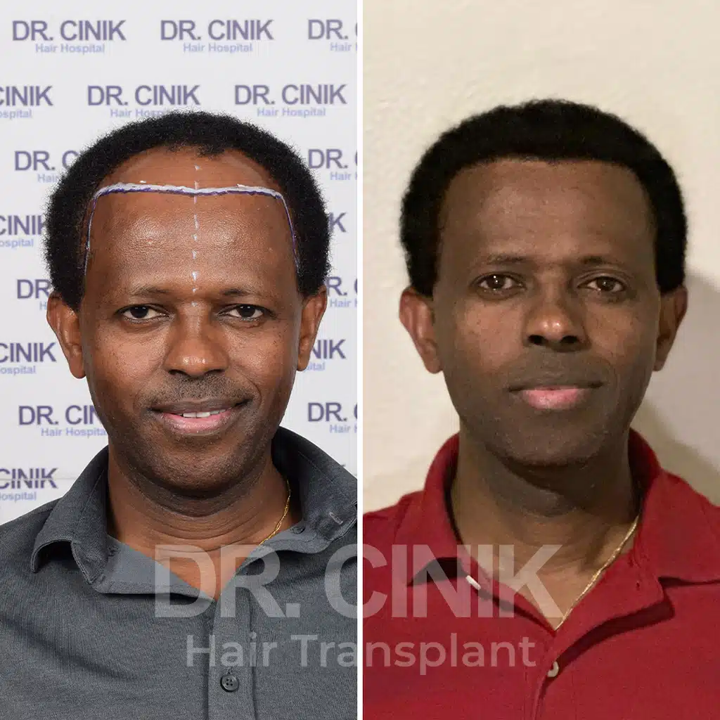 Comparación antes y después de un trasplante capilar afro con 3650 injertos. Patrón inicial Norwood IV mostrando la transformación.