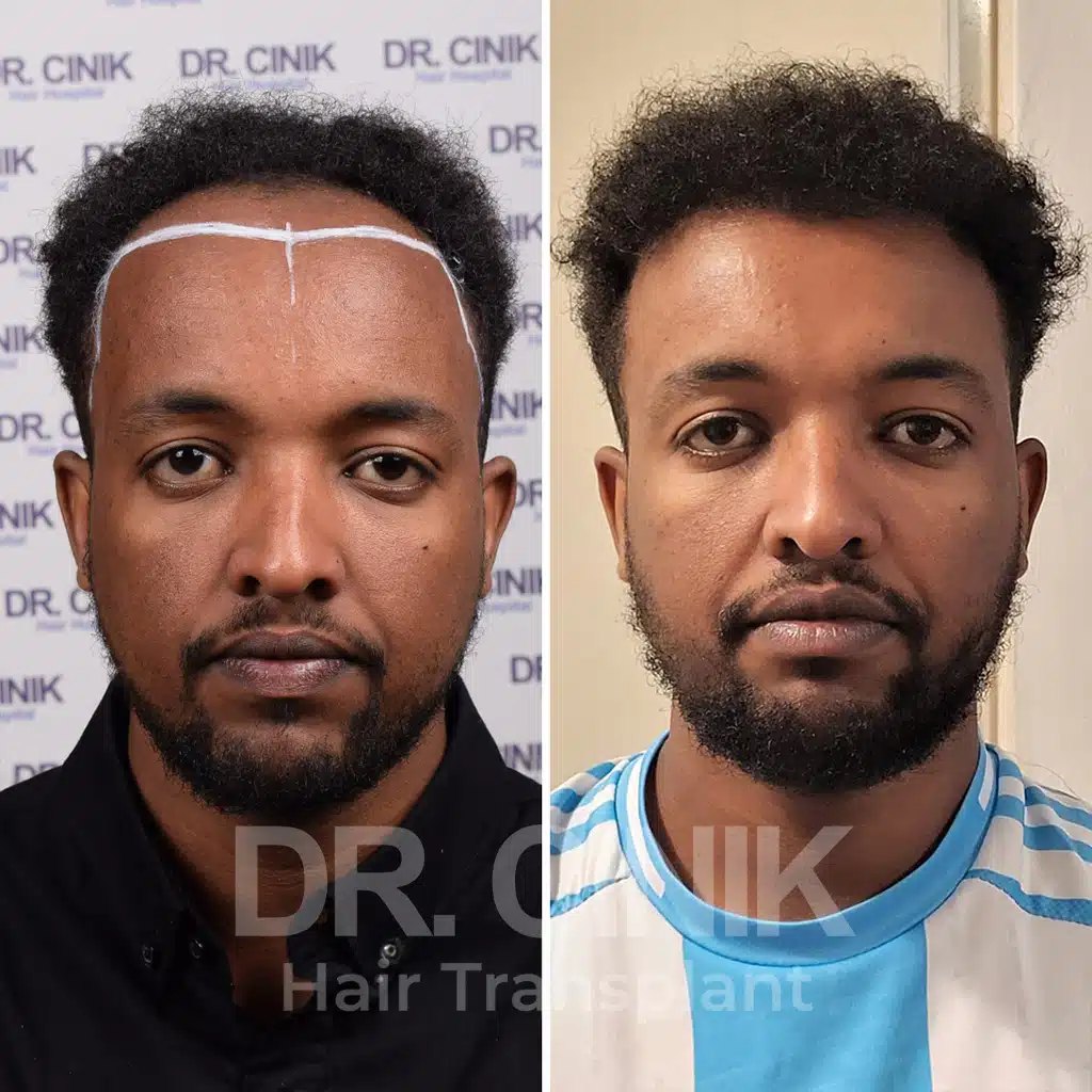Comparación antes y después de un trasplante capilar afro con 3700 injertos. Patrón inicial Norwood III mostrando la transformación.