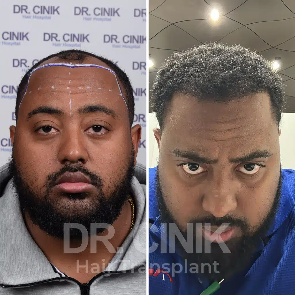 Comparación antes y después de un trasplante capilar afro con 3700 injertos. Patrón inicial Norwood IV mostrando la transformación.