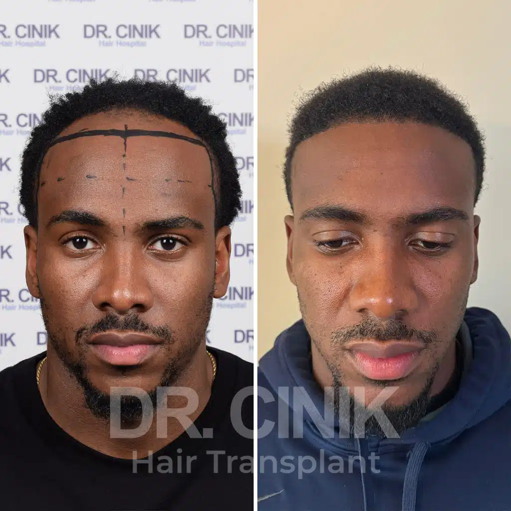 Comparación antes y después de un trasplante capilar afro con 3750 injertos. Patrón inicial Norwood IV mostrando la transformación.