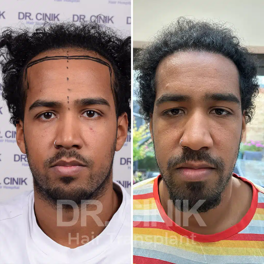 Comparación antes y después de un trasplante capilar afro con 3750 injertos. Patrón inicial Norwood V mostrando la transformación.
