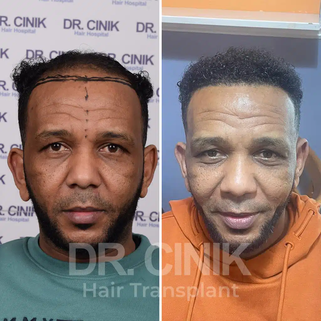 Comparación antes y después de un trasplante capilar afro con 3800 injertos. Patrón inicial Norwood V mostrando la transformación.