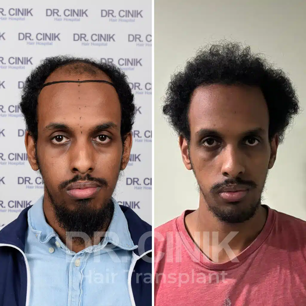Comparación antes y después de un trasplante capilar afro con 3900 injertos. Patrón inicial Norwood VI mostrando la transformación.