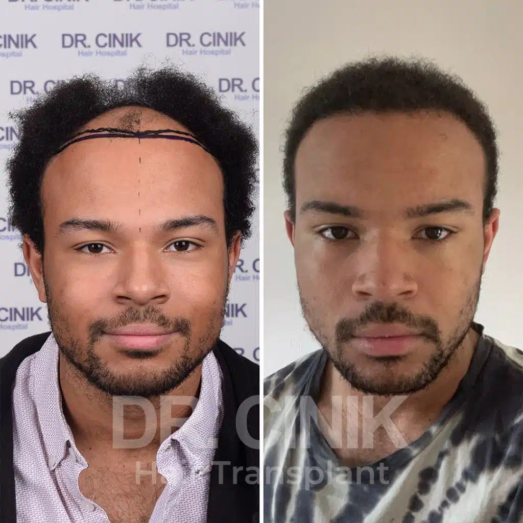 Comparación antes y después de un trasplante capilar afro con 4000 injertos. Patrón inicial Norwood V mostrando la transformación.