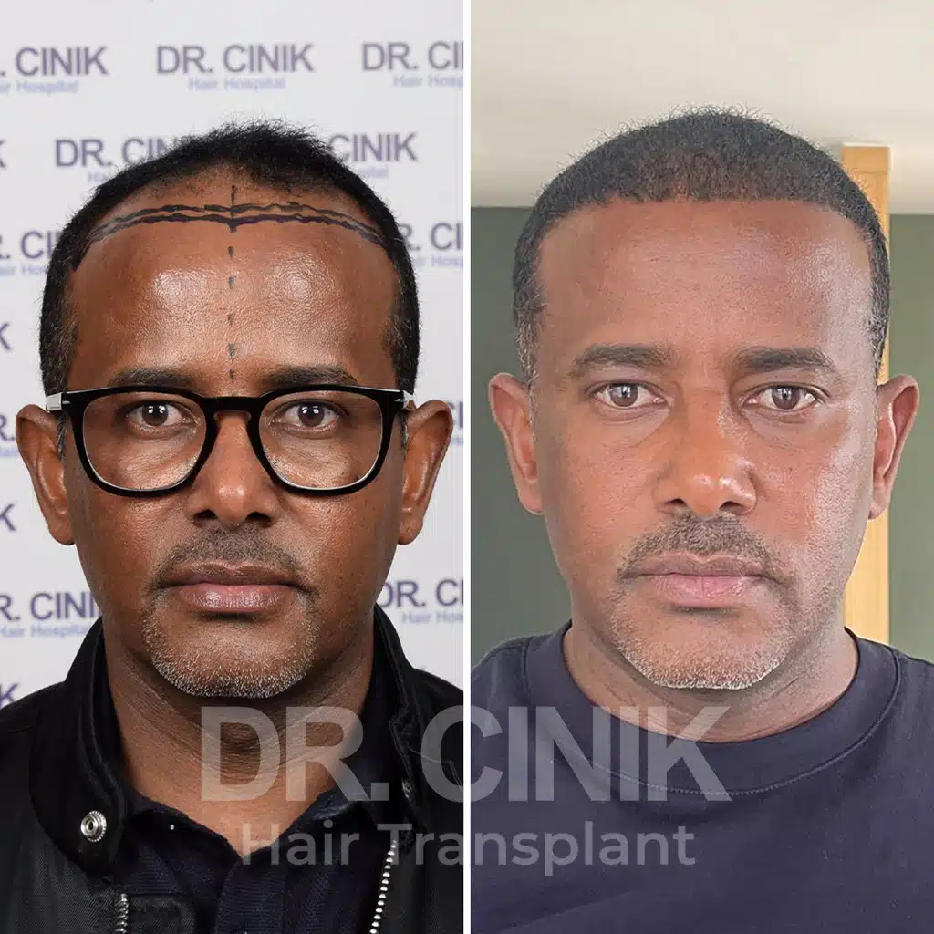 Comparación antes y después de un trasplante capilar afro con 4100 injertos. Patrón inicial Norwood V mostrando la transformación.