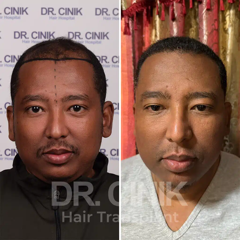 Comparación antes y después de un trasplante capilar afro con 4150 injertos. Patrón inicial Norwood V mostrando la transformación.