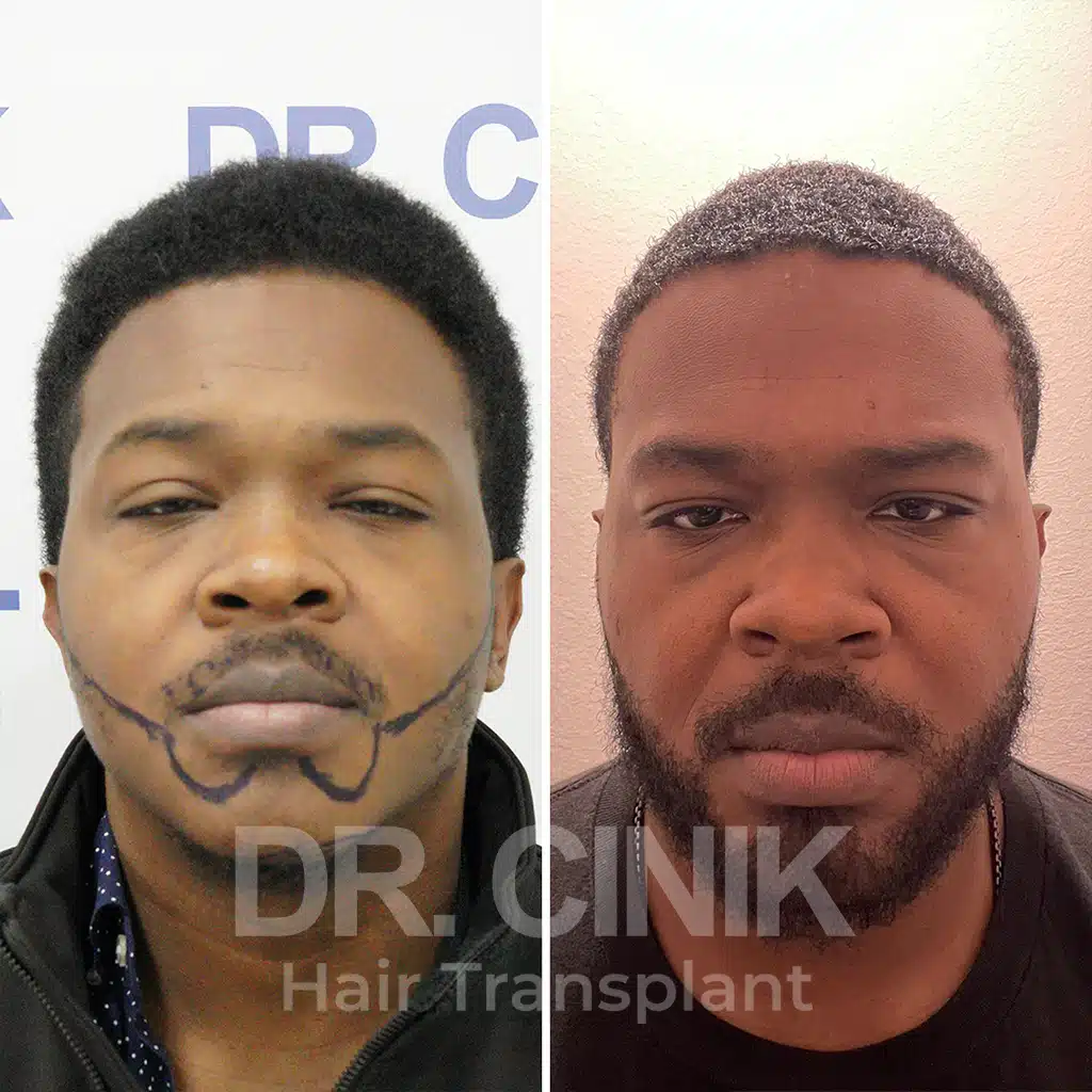 Comparación antes y después de un trasplante capilar afro con 4275 injertos, mostrando la transformación tras el procedimiento.