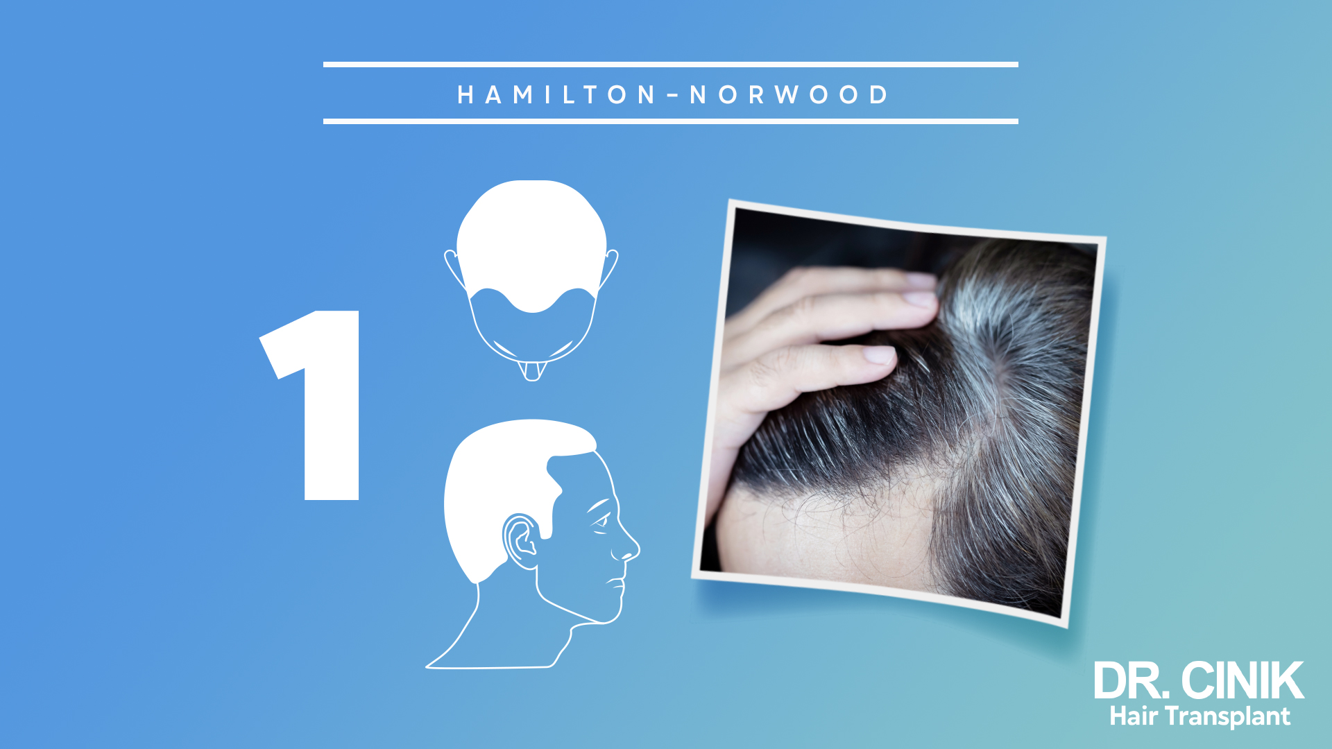 Gráfico que representa la escala "HAMILTON-NORWOOD" relacionada con la pérdida de cabello. El fondo es de color azul claro. Hay un número grande "1" en el lado izquierdo, indicando que se trata de la etapa 1 de la escala. Al centro, hay dos ilustraciones en blanco: la de arriba muestra la parte superior de una cabeza con una línea delgada de cabello faltante en la coronilla, mientras que la de abajo es el perfil de un hombre con cabello completo. A la derecha, hay una imagen real de la parte superior de la cabeza de una persona, mostrando una pequeña cantidad de pérdida de cabello en la coronilla mientras una mano está tocando el cabello. En la esquina inferior derecha, está el logo "DR. CINIK Hair Transplant".