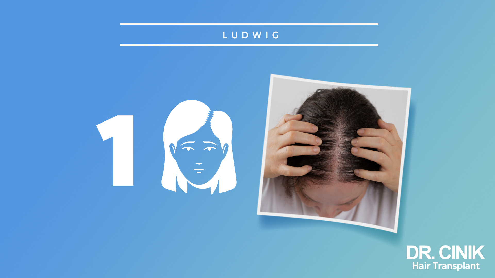 Imagen que muestra el primer paso de la escala Ludwig. A la izquierda, hay un gráfico con el número 1 y una ilustración de una mujer con cabello fino. A la derecha, una foto de una mujer sosteniendo su cabello mostrando adelgazamiento en la parte superior de la cabeza. Fondo azul con texto que dice 'DR. CINIK Hair Transplant'.