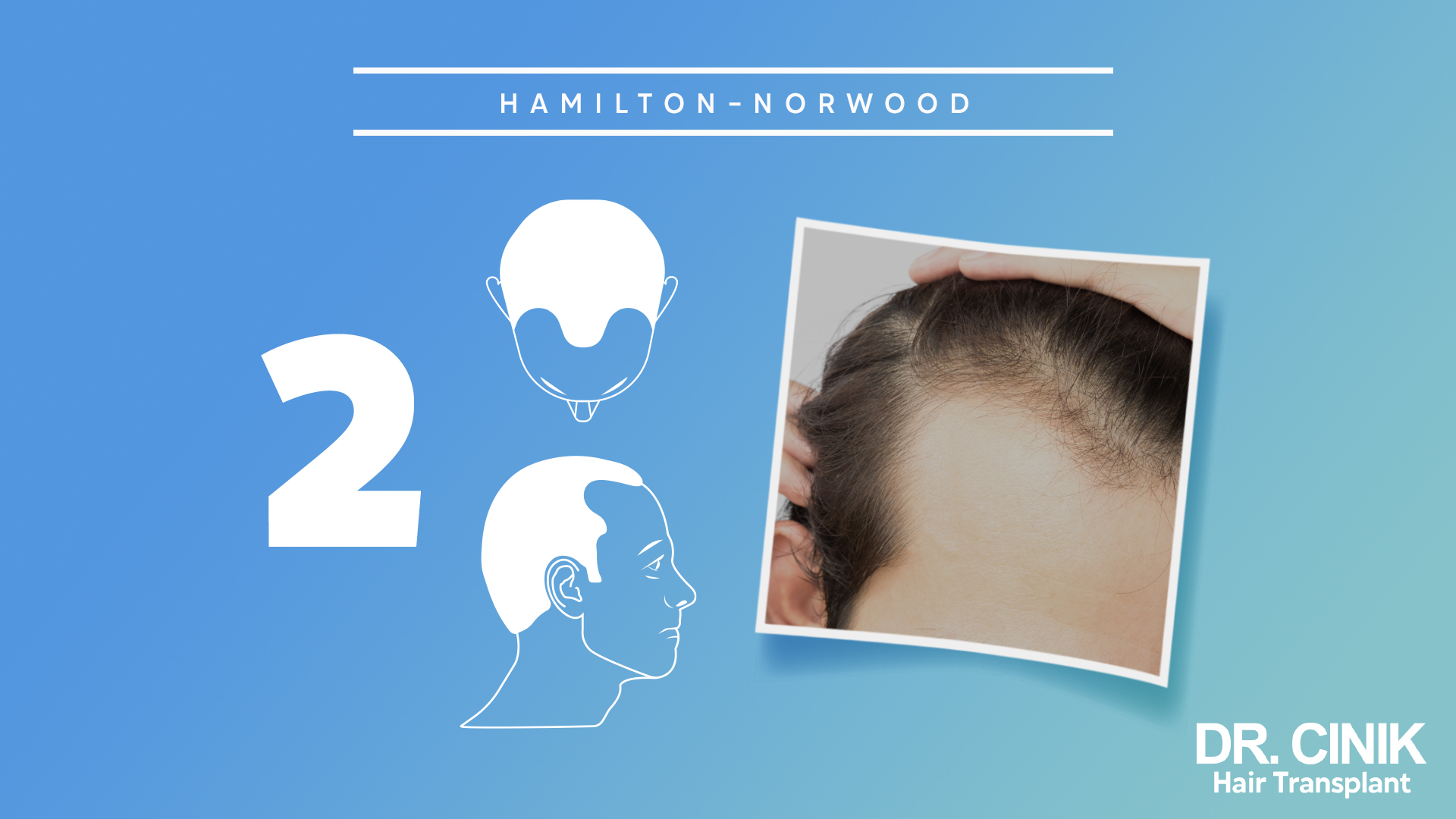 
Este gráfico representa la etapa 2 de la escala "HAMILTON-NORWOOD", que se utiliza para categorizar los niveles de pérdida de cabello en hombres.

El fondo es de color azul claro con un número grande "2" en el lado izquierdo, indicando que se trata de la segunda etapa de la escala. En el centro, hay dos ilustraciones en blanco: la superior muestra la parte superior de una cabeza con una ligera pérdida de cabello en la coronilla y la inferior es un perfil de un hombre que también indica una leve pérdida de cabello.

A la derecha, hay una imagen real de la parte superior de la cabeza de una persona, mostrando una pérdida de cabello más notable en la coronilla. La piel del cuero cabelludo es claramente visible.

En la esquina inferior derecha, aparece el logo "DR. CINIK Hair Transplant". 