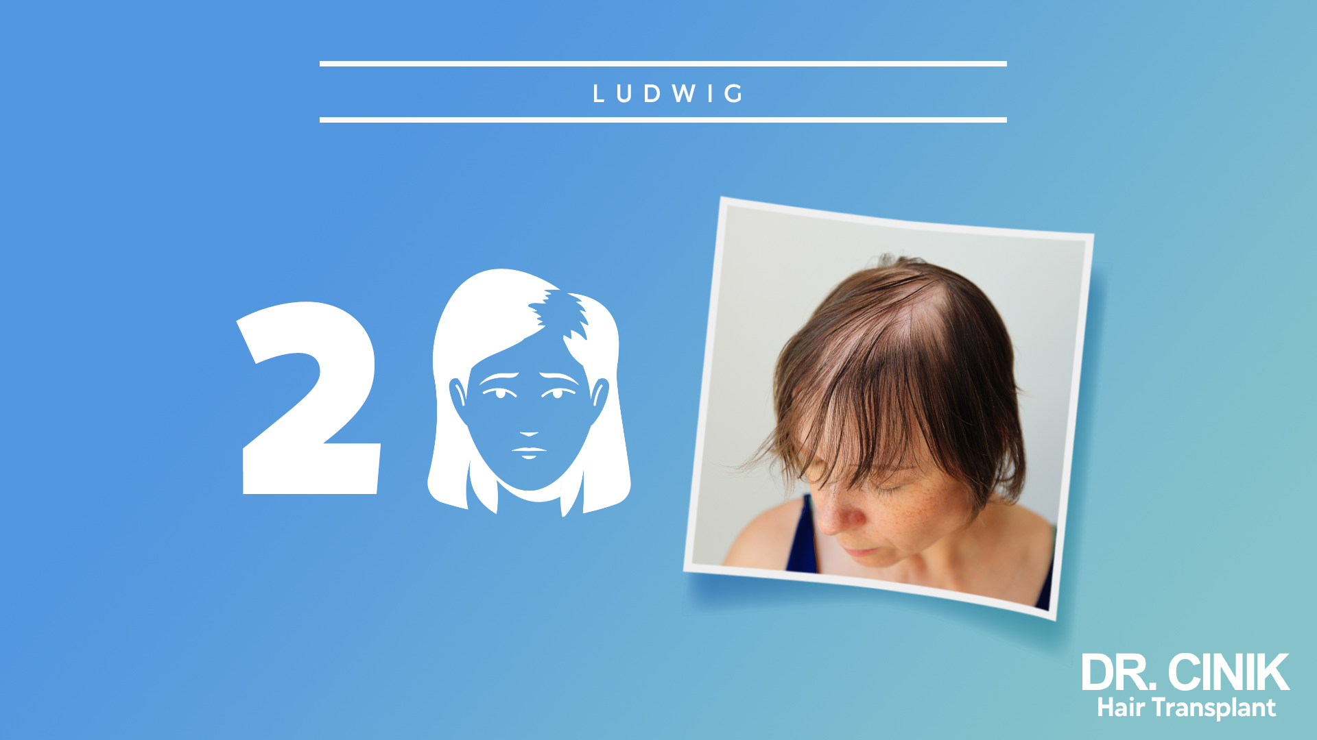 Imagen que muestra el segundo paso de la escala Ludwig. A la izquierda, hay un gráfico con el número 2 y una ilustración de una mujer con mayor adelgazamiento del cabello. A la derecha, una foto de una mujer mostrando pérdida significativa de cabello en la parte superior de la cabeza. Fondo azul con texto que dice 'DR. CINIK Hair Transplant'.
