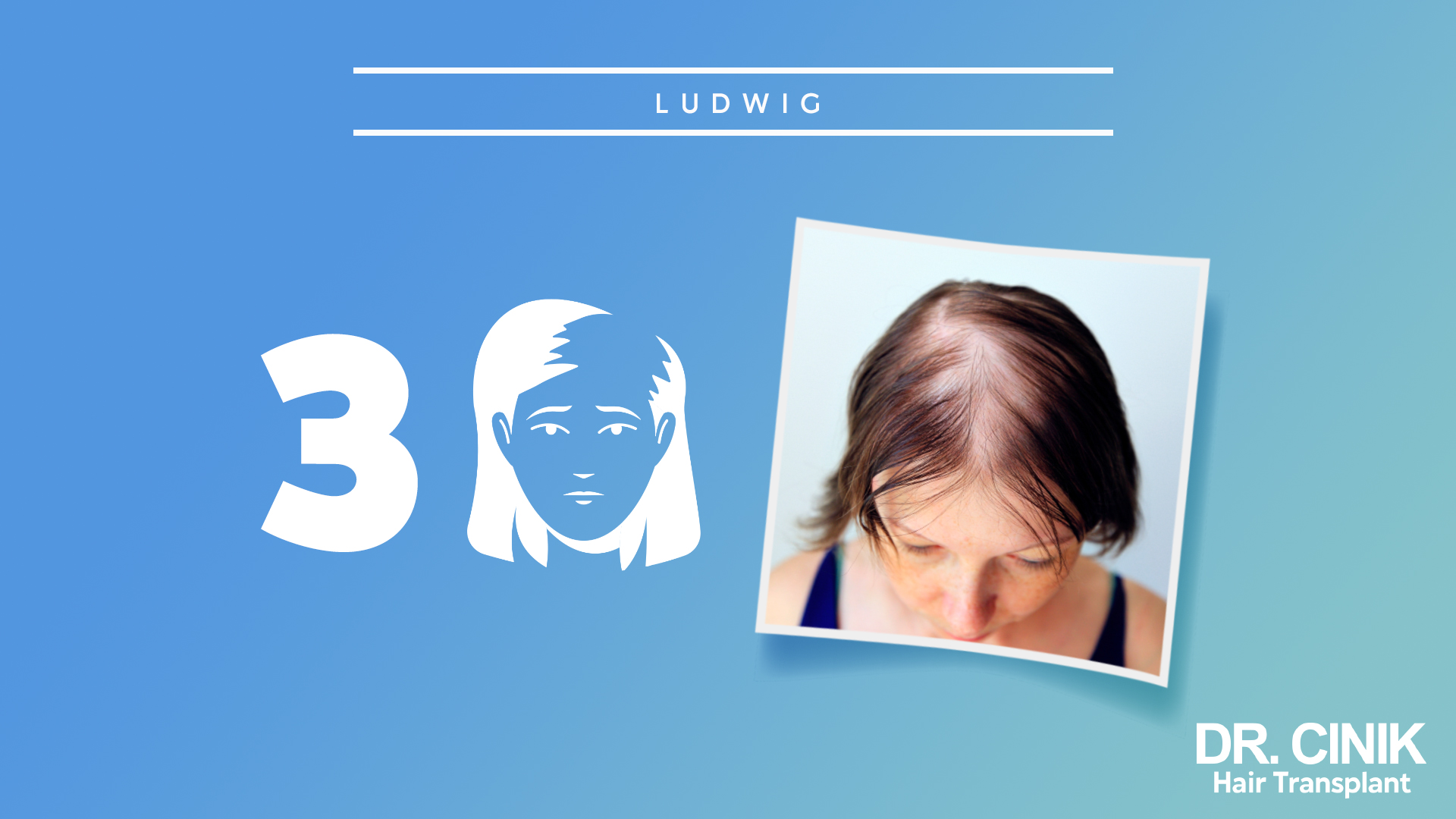 Imagen que muestra el tercer paso de la escala Ludwig. A la izquierda, hay un gráfico con el número 3 y una ilustración de una mujer con una pérdida de cabello aún más avanzada. A la derecha, una foto de una mujer mostrando una pérdida de cabello muy notable en la parte superior de la cabeza. Fondo azul con texto que dice 'DR. CINIK Hair Transplant'