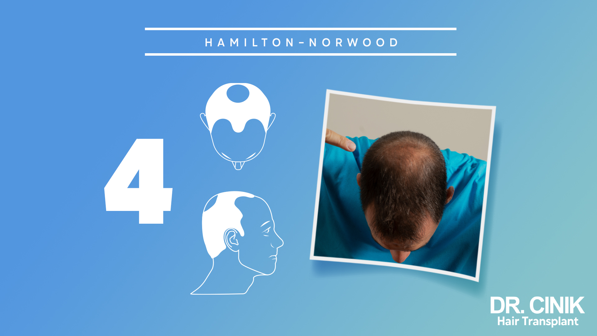 Este gráfico representa la etapa 4 de la escala "HAMILTON-NORWOOD", que se utiliza para categorizar los niveles de pérdida de cabello en hombres.

El fondo es de color azul claro con un número grande "4" en el lado izquierdo, indicando que se trata de la cuarta etapa de la escala. En el centro, hay dos ilustraciones en blanco: la superior muestra una vista frontal de una cabeza con una pérdida de cabello más acentuada en la zona de la coronilla, mientras que la imagen inferior muestra un perfil de un hombre con una recesión notable en la línea del cabello y una zona calva más grande en la parte superior.

A la derecha, hay una fotografía real de la parte superior de la cabeza de una persona, que muestra una pérdida de cabello significativa, con una zona calva más extensa en la parte superior del cuero cabelludo.

En la esquina inferior derecha, aparece el logo "DR. CINIK Hair Transplant".
