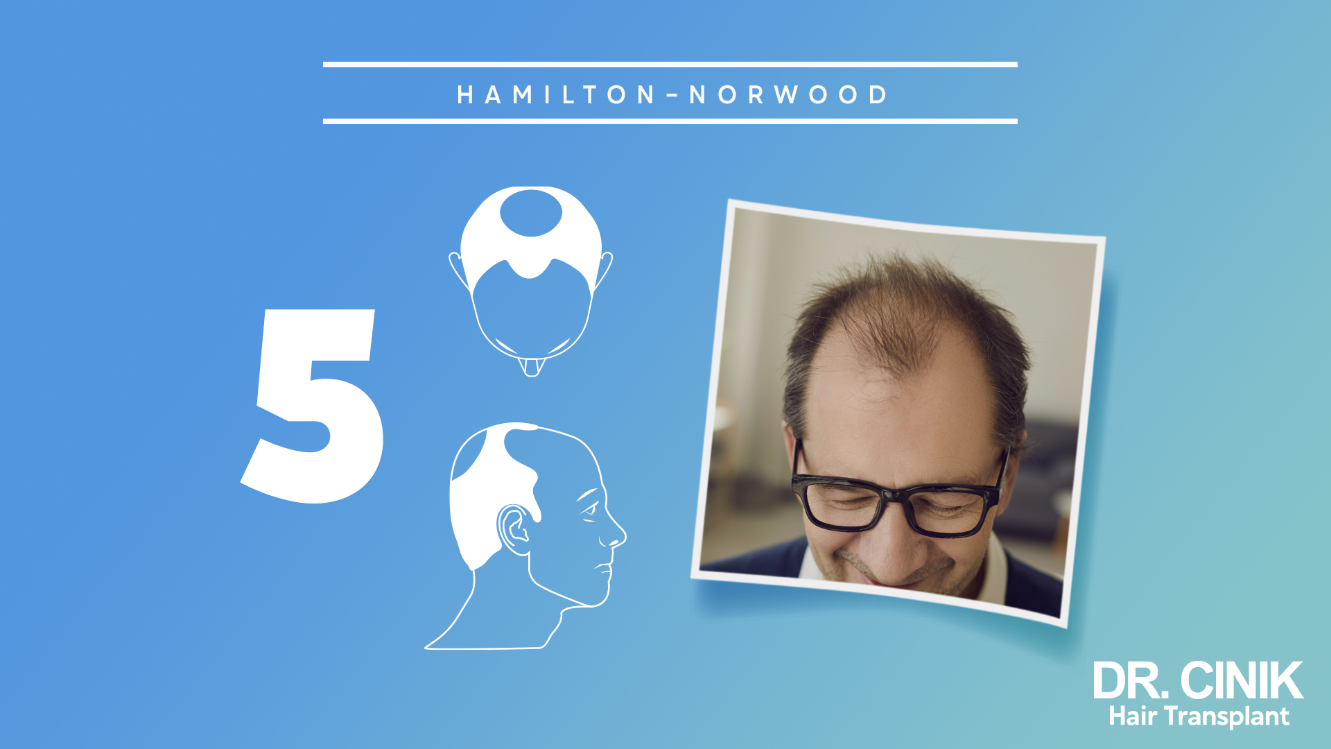 Esta gráfica representa la etapa 5 de la escala "HAMILTON-NORWOOD", que se utiliza para categorizar los niveles de pérdida de cabello en hombres.