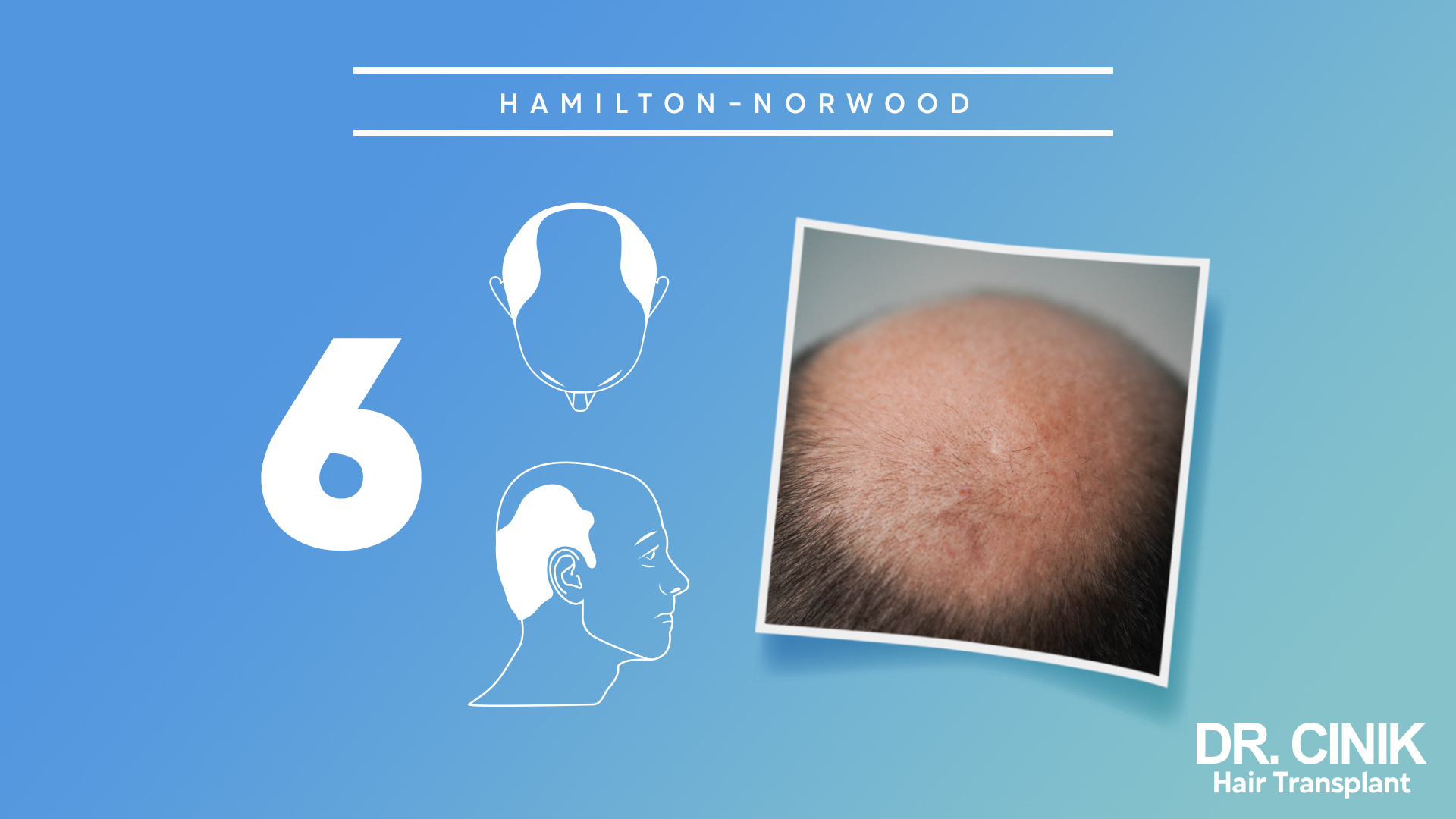 Esta imagen muestra la etapa 6 de la escala "HAMILTON-NORWOOD", que se utiliza para clasificar los niveles de pérdida de cabello en hombres.