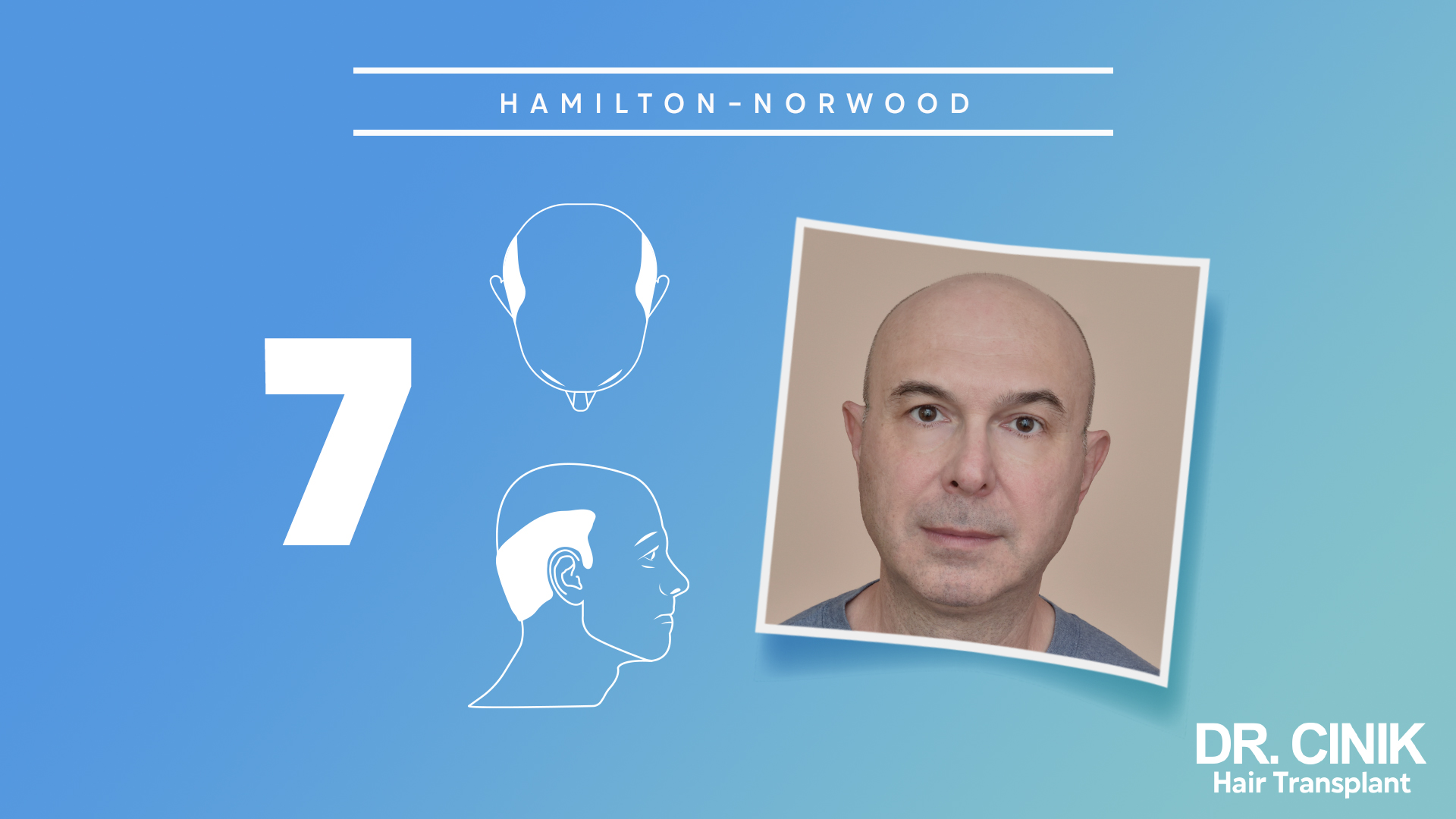 
ChatGPT
Esta imagen representa la etapa 7 de la escala "HAMILTON-NORWOOD", que clasifica los niveles de alopecia en hombres. Se observa un diagrama de un perfil masculino mostrando una avanzada pérdida de cabello en la parte superior de la cabeza. Junto al diagrama, hay una fotografía de un hombre real que ejemplifica esta etapa de alopecia.