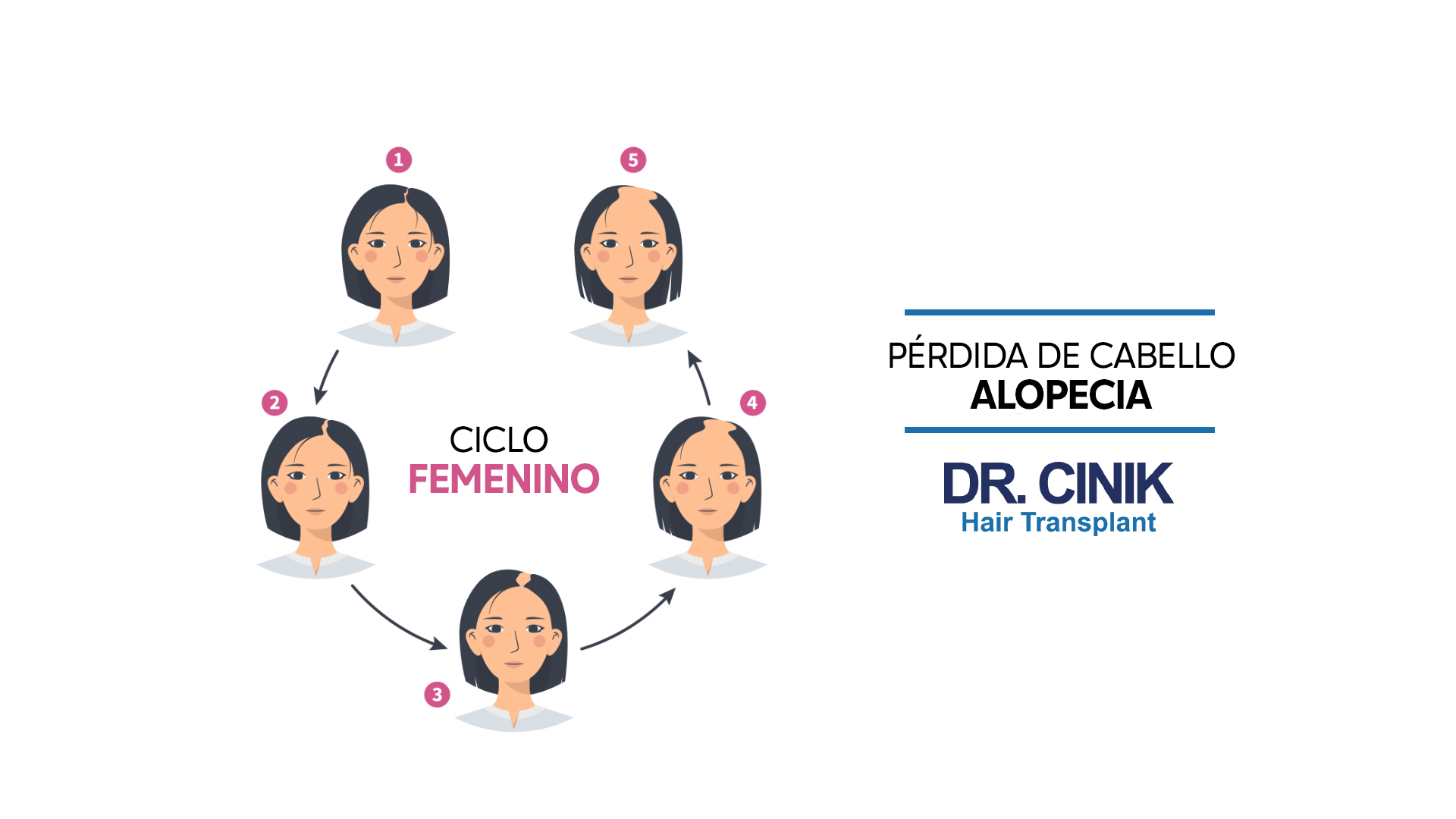 Ilustración que muestra las etapas de la alopecia de patrón femenino titulada "CICLO FEMENINO". Cinco retratos de una mujer, numerados del 1 al 5, muestran la progresión de la pérdida de cabello desde un cabello completo hasta una alopecia avanzada. Las flechas indican el flujo desde una etapa a la siguiente. En la parte superior derecha, las palabras "PÉRDIDA DE CABELLO ALOPECIA" y el logo "DR. CINIK Hair Transplant" están presentes. El fondo es blanco y los retratos y textos están en colores negro, rosa y azul.