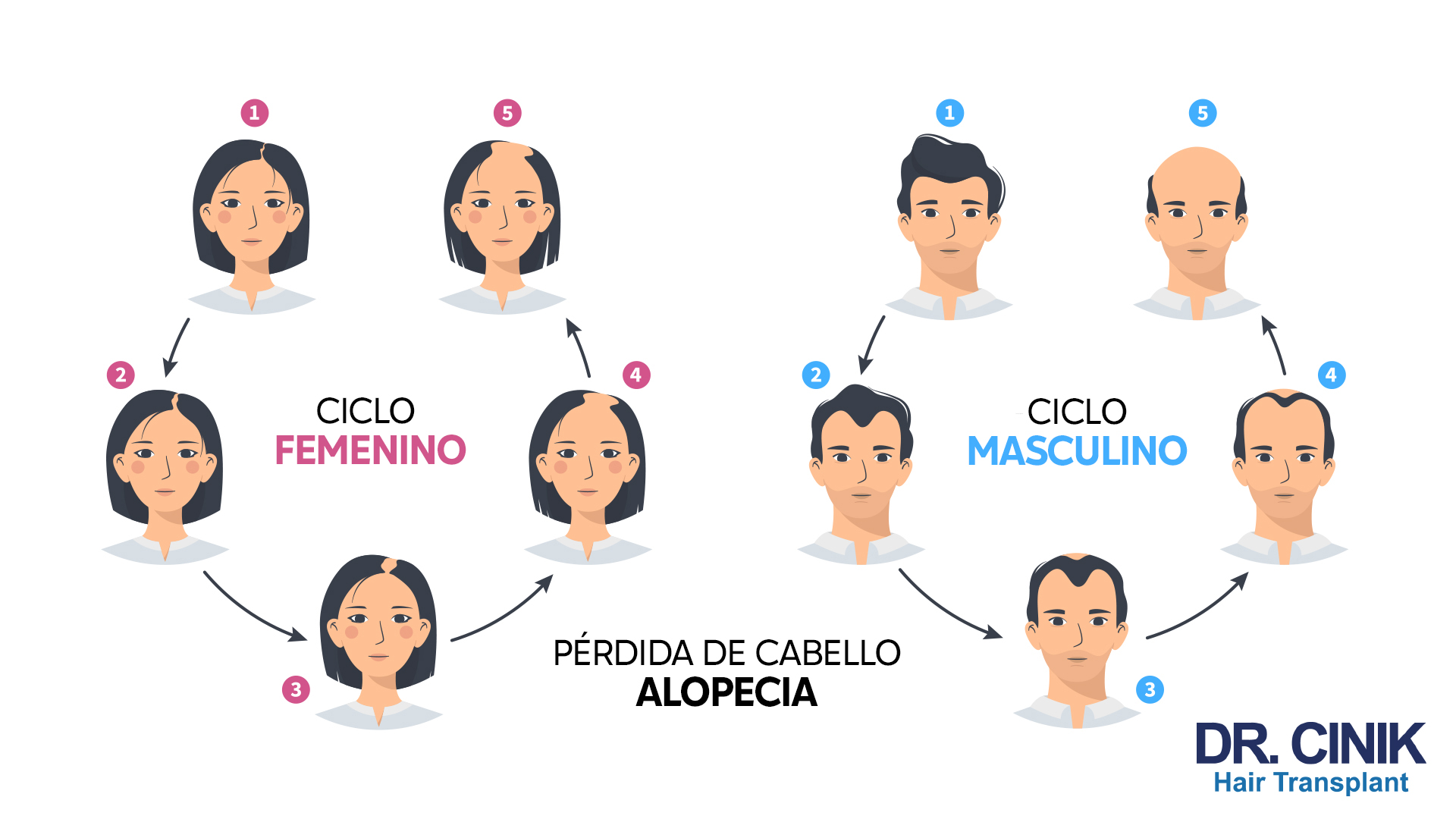 Ilustración que compara el "CICLO FEMENINO" y el "CICLO MASCULINO" de pérdida de cabello. En el lado izquierdo, tres retratos de una mujer en diferentes etapas de pérdida de cabello con flechas que indican la progresión desde el cabello completo, adelgazamiento y mayor pérdida, etiquetadas con números del 1 al 3. En el centro inferior, el texto "PÉRDIDA DE CABELLO ALOPECIA". En el lado derecho, similar al femenino, tres retratos de un hombre que muestran etapas desde cabello completo, adelgazamiento hasta calvicie avanzada, etiquetados con números del 1 al 3. Ambos ciclos tienen dos retratos adicionales, etiquetados como 4 y 5, que representan etapas posteriores en el ciclo. En la esquina inferior derecha, el logo "DR. CINIK Hair Transplant".