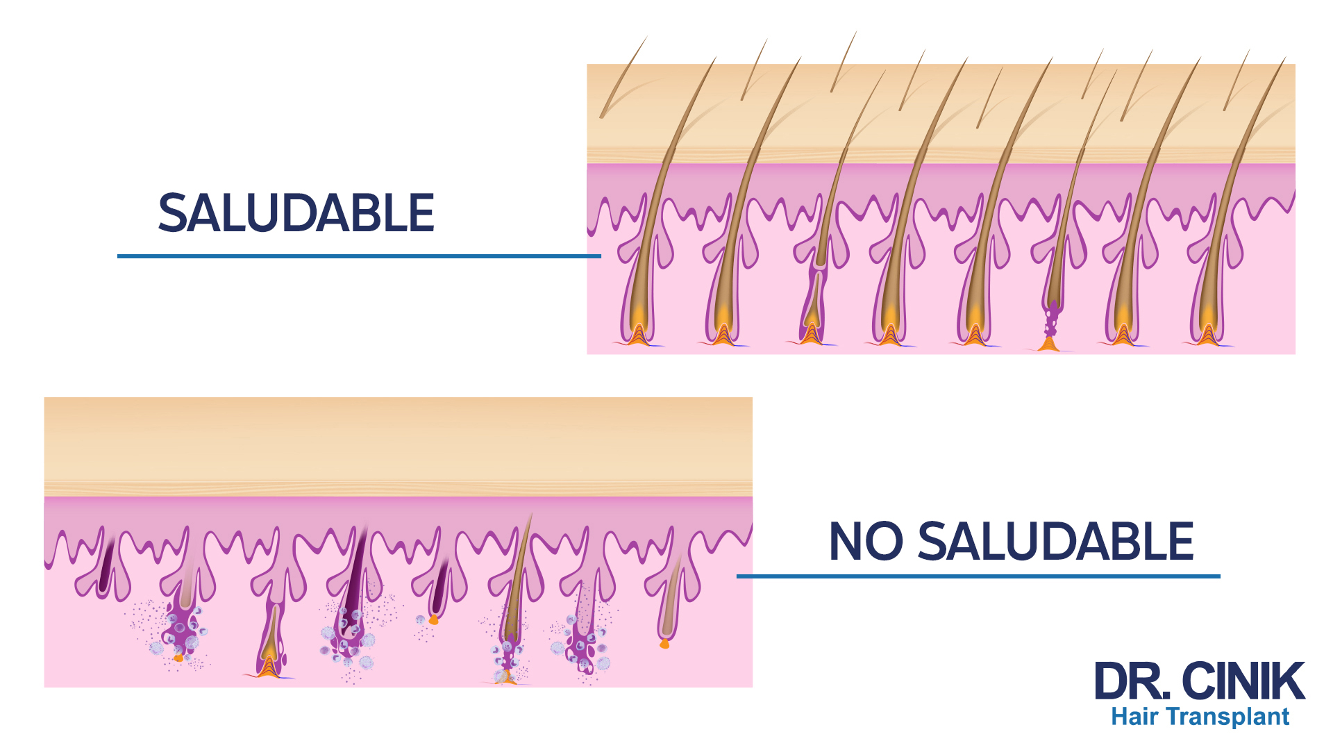 Gráfico comparativo de un cuero cabelludo afectado por alopecia areata versus un cuero cabelludo sano. La sección superior, etiquetada como 'SALUDABLE', muestra una sección transversal de un cuero cabelludo sano con mechones de cabello emergiendo de folículos pilosos intactos y una dermis sin inflamación. La sección inferior, etiquetada como 'NO SALUDABLE', muestra un cuero cabelludo afectado por alopecia areata con folículos pilosos dañados y una inflamación circundante, indicando las características áreas de pérdida de cabello de la condición. Se proporciona una representación detallada del cabello, los folículos y la piel circundante. En la esquina inferior derecha aparece el logo de 'DR. CINIK Hair Transplant'.