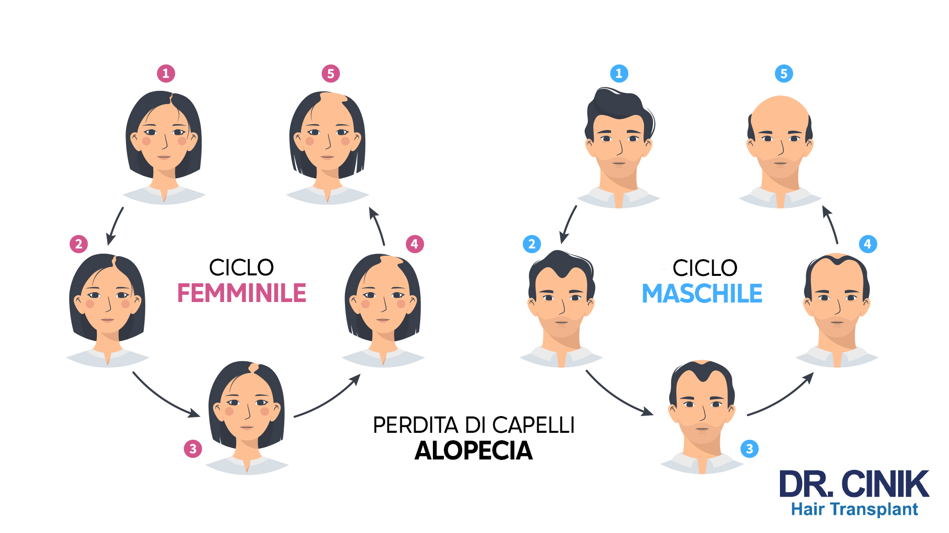 Un'infografica che illustra la progressione della perdita di capelli nei cicli femminili e maschili. A sinistra, sotto la dicitura "CICLO FEMMINILE", si mostra una donna con cinque fasi di diradamento progressivo al centro della testa. A destra, sotto "CICLO MASCHILE", è rappresentato un uomo con cinque fasi di arretramento della linea frontale dei capelli e diradamento nella zona superiore della testa. In basso al centro, il testo "PERDITA DI CAPELLI ALOPECIA" con il logo di "DR. CINIK Hair Transplant".