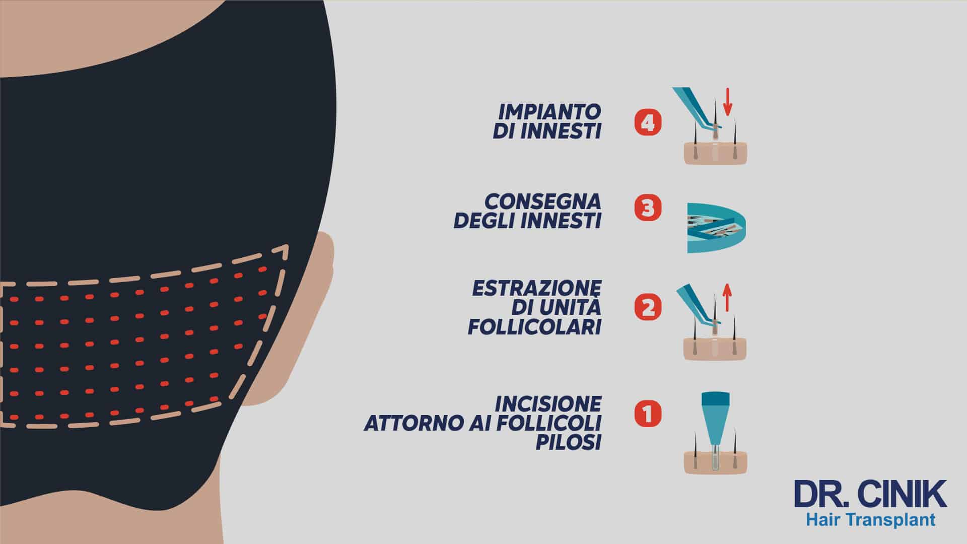 Schema illustrativo di una procedura di trapianto di capelli FUE. La procedura mostra quattro fasi: incisione intorno ai follicoli pilosi, estrazione delle unità follicolari, consegna degli innesti e impianto degli innesti. L'immagine presenta la parte posteriore della testa con una zona donatrice delimitata da linee tratteggiate rosse, con ogni fase accompagnata da un'icona rappresentativa dell'azione eseguita.